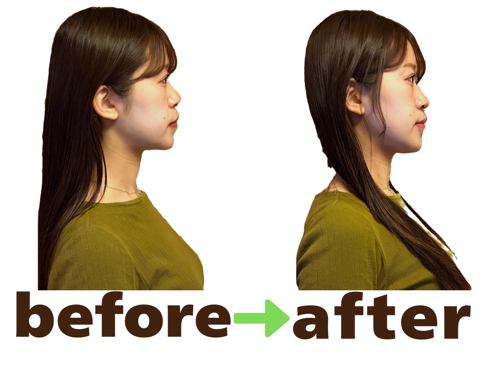 美容鍼のBefore After｜フェイスラインと首のラインの変化