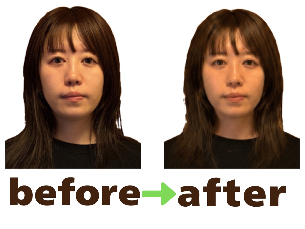 美容鍼のBefore After｜正面から見たお顔のむくみ・輪郭の変化